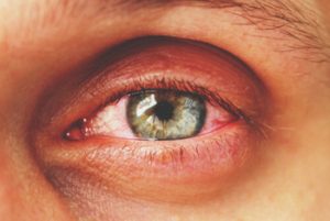 how to relieve pain after laser eye surgery symptoms