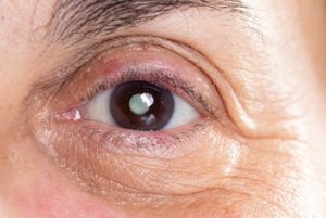 Cataract Surgery Vs. Laser Eye Surgery symptoms
