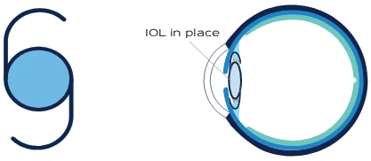 Intraocular lens replacement at ELS