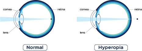 corneal tissue vision problems