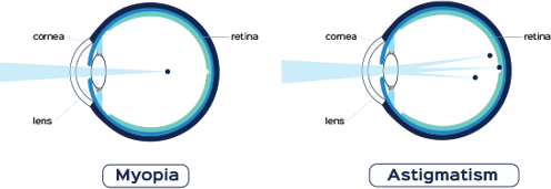 corneal tissue vision problems