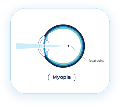 Myopia