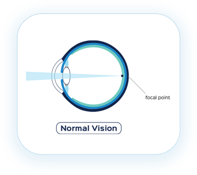 Normal Vision