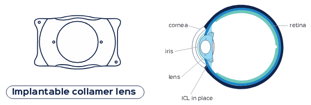 implantable collamer lens (ICL)