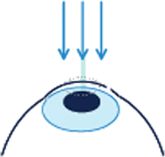 How different laser surgeries work