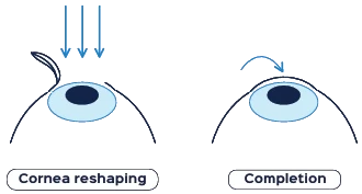 Cornea reshaping and completion
