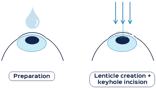 How does SMILE® Pro surgery work