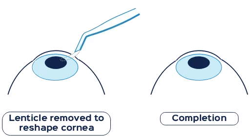 How does SMILE® Pro surgery work