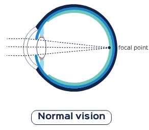 Young eye before presbyopia Melbourne
