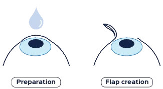 Preparation Flap creation